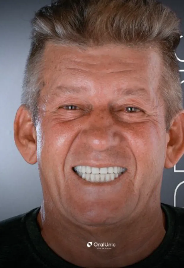 Depois do protocolo sobre implantes